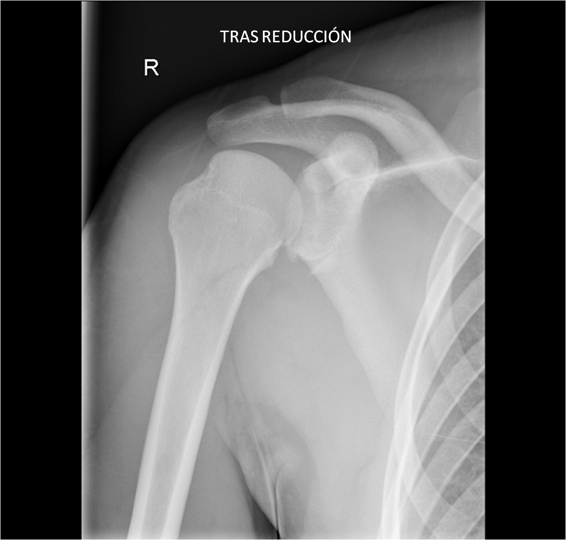 Luxación Del Hombro; Luxación Glenohumeral
