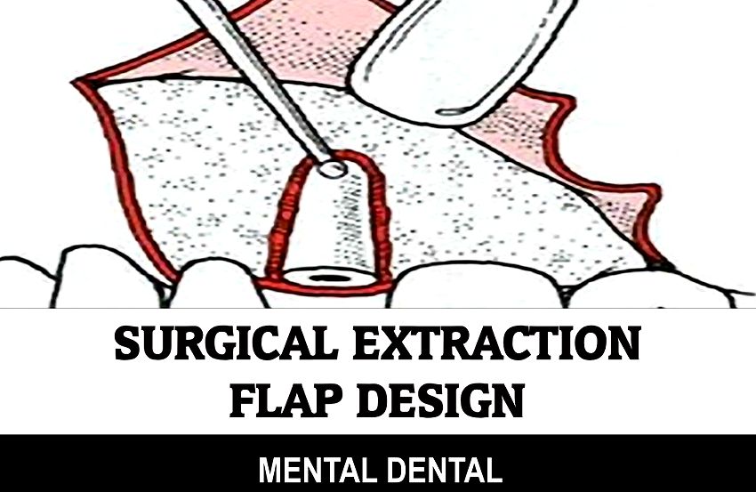 EXODONTICS Surgical Extraction Flap Design OdontoTv