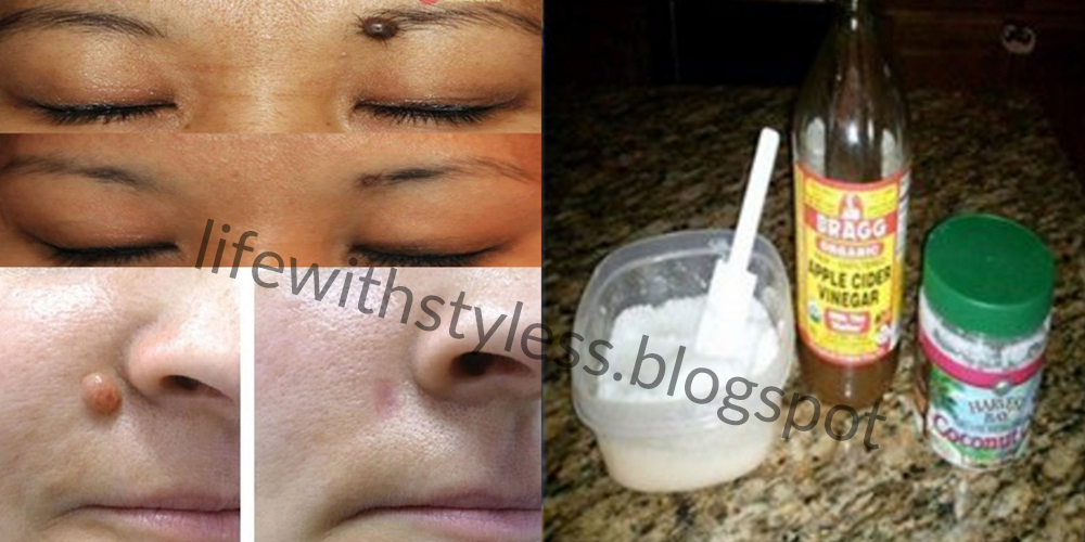 How to Get Rid of Warts Using Apple Cider Vinegar at Home Life With Styles