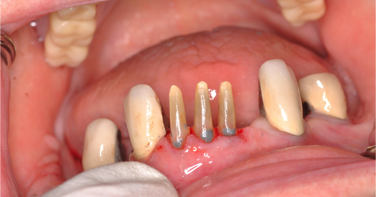 Dental Info So many choices for crown preparation designs?