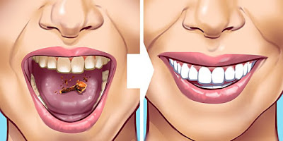 Détartrage dentaire maison : Astuces pour éliminer la plaque dentaire