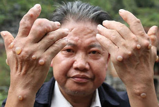 Mengobati Bintil Kutil ada di Area Kelamin, Apa Obat Kutil di Kemaluan Pada Pria, Artikel Obat Untuk Mengobati Kutil di Kelamin