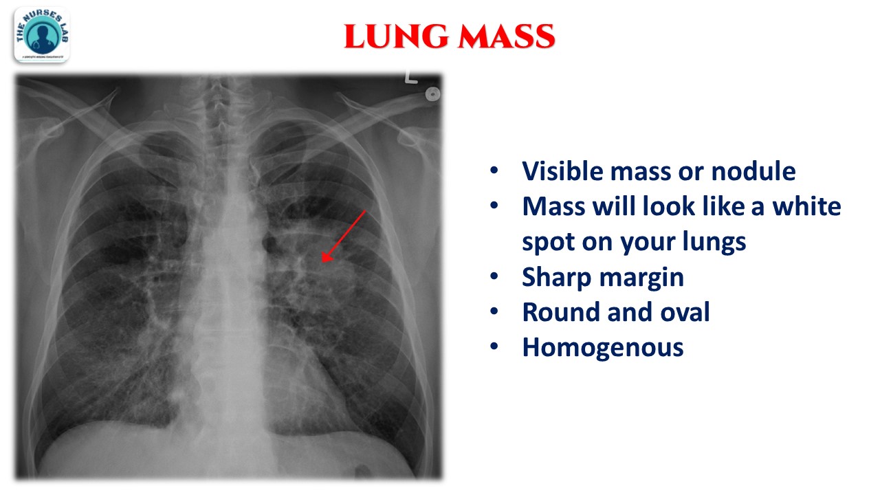 Abnormal Chest Xray Interpretation