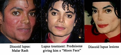 lupus operacje plastyczne wysypka twarzy mj wy