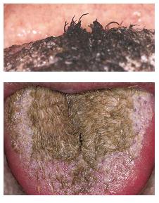 Hairy Tongue in Adults: Condition, Treatments, and ...