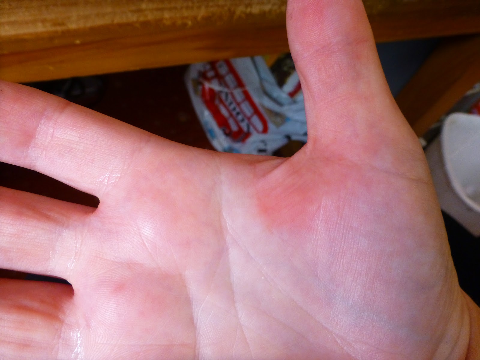 velovoice-sore-hands