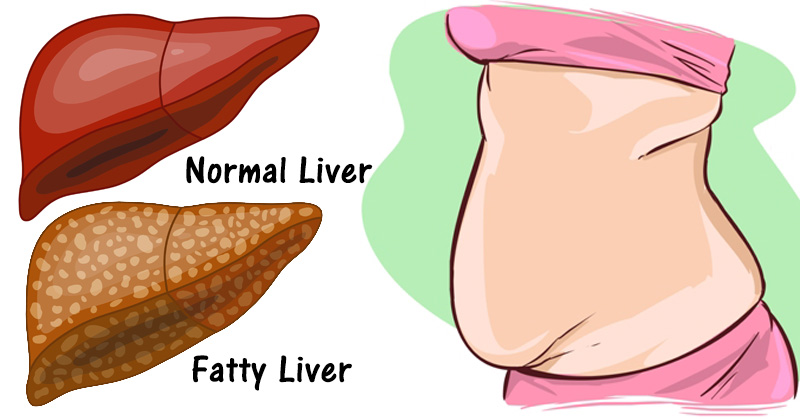 7 Signs That Your Liver And Full Of Toxins (And How To Detoxify It)