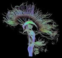 An image of fiber tracts in the brain, obtained using Diffusion Tensor Imaging.