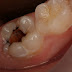 Quy trình tiến hành điều trị răng sâu tới tủy