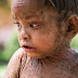 2-year-old Indian girl suffers from rare skin condition causing her to develop reptile-like scales