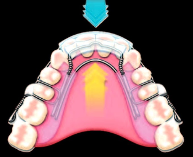 PDF: The evolution of the Spring Aligner for treating orthodontic relapse and Mild Crowding