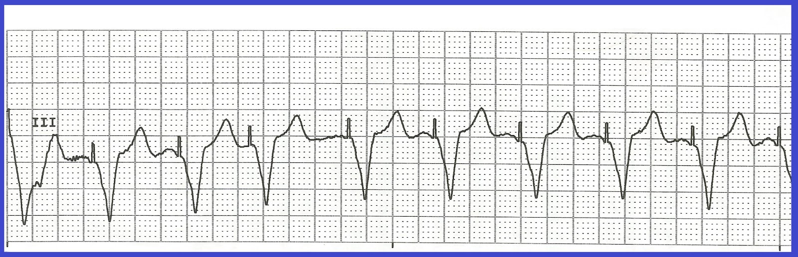 Float Nurse Basic EKG Rhythm Test 08