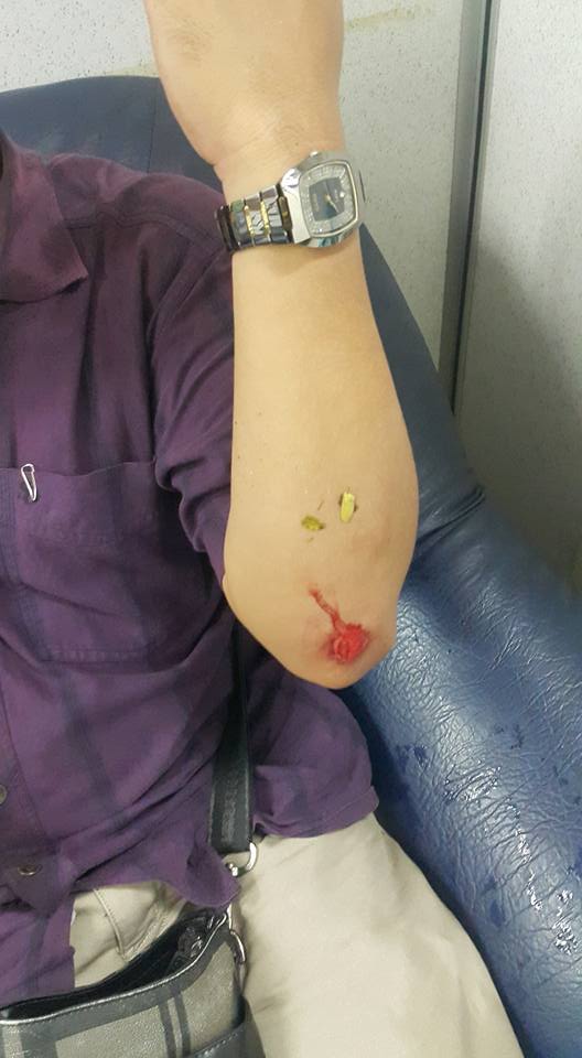 Luka Jatuh Dari Motor Di Tangan - Paimin Gambar