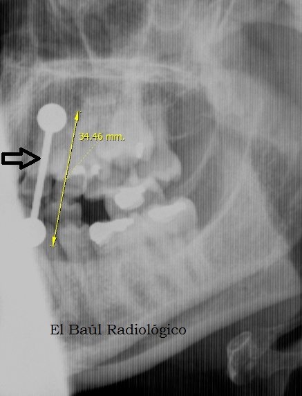 El Baúl Radiológico: "PIERCINGS" Y RESONANCIA MAGNÉTICA and MRI) by luis mazas Septiembre 2012.