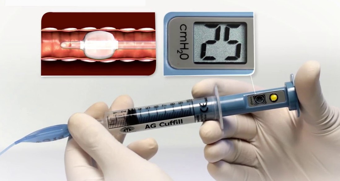 Methods to stabilize ETT intracuff pressure Anesthesia Morbidity and