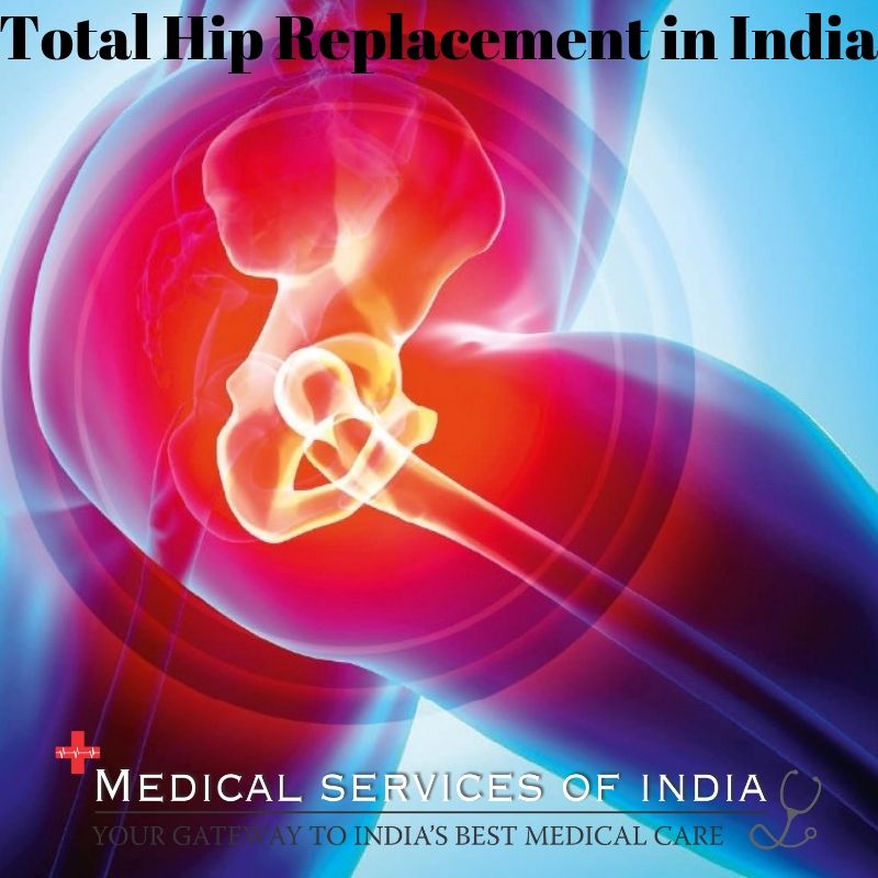 Know Benefits and Risk of Total Hip Replacement Surgery in India