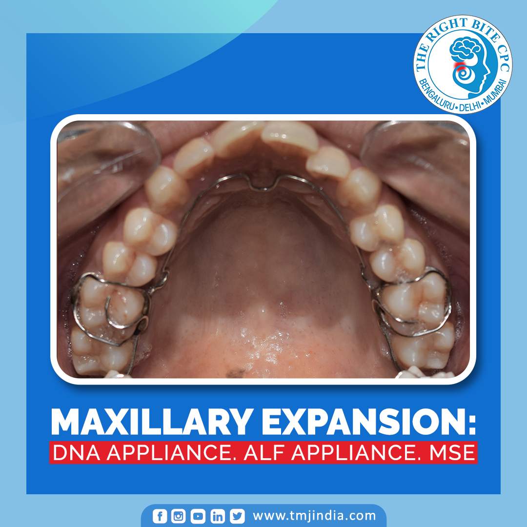 Treatment For TMJ Disorders Maxillary Expansion DNA appliance. ALF