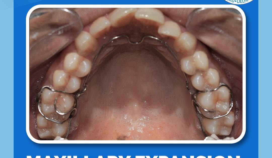 Treatment For TMJ Disorders Maxillary Expansion DNA appliance. ALF