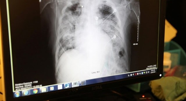 Transplante pulmonar duplo salva doente de 31 anos no pós-covid