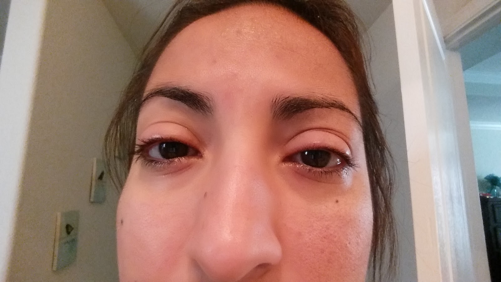 Yvette's Multiple Myeloma Journey Red swollen eyes