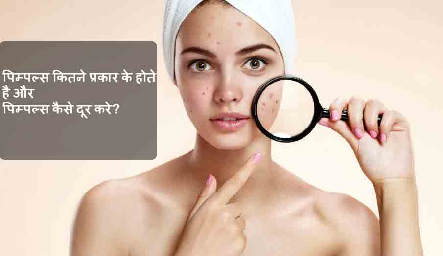 Types of Pimples and How to remove Pimples In Hindi