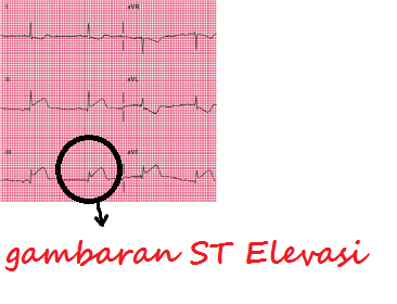 Cara Mudah Membedakan Stemi, Nstemi dan UAP - Jantung Area