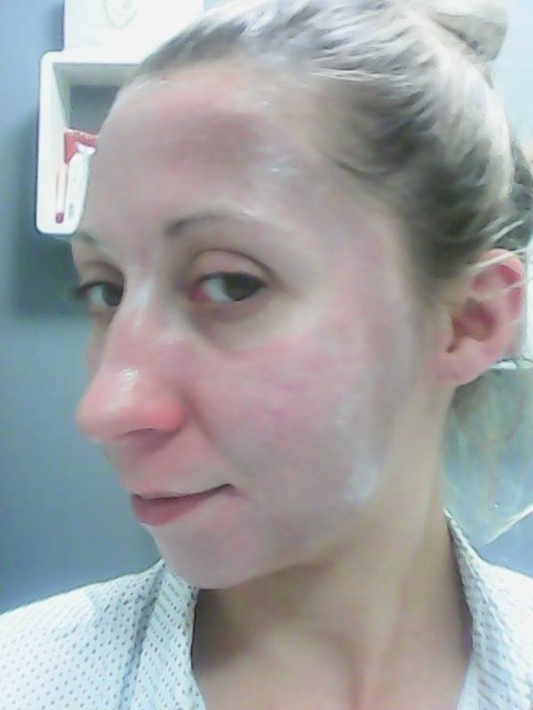 Peau qui pèle dermite Peau qui pèle dermite