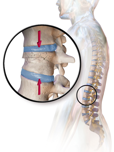 acute l1 compression fracture treatment acute l1 compression fracture treatment