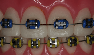 Elastik ligatürler model üzerinde (renkli diş teli)
