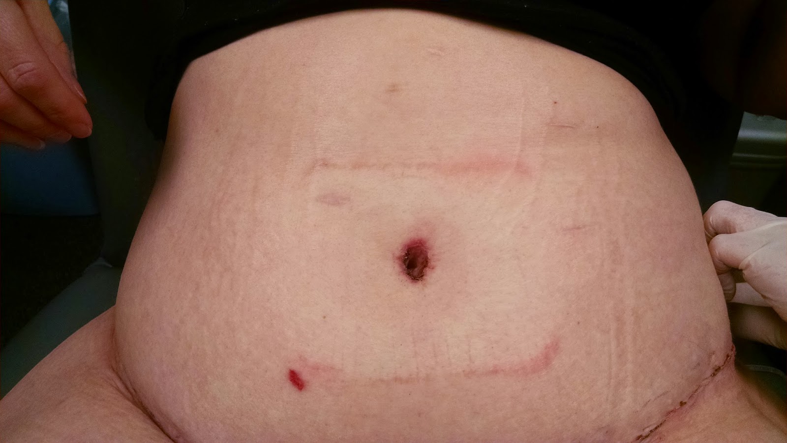 How Long Do Blood Blisters Last On Your Finger This page presents