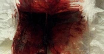 Cara Merawat Berak Berdarah / Punca Berak Berdarah Adalah Sebab 9