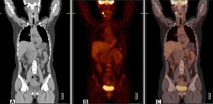 Positron Emission Tomography - Computed Tomography (PET/CT) Scan ...