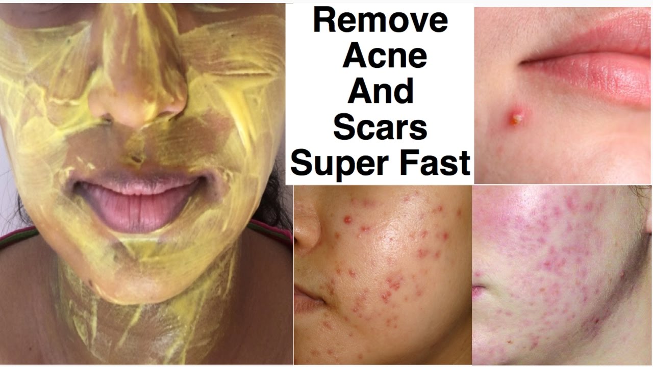 5 Home Remedies For Acne Scars For Your Skin