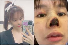 Chinese actress Gao Liu shares pictures of her decaying nose as she warns against the dangers of plastic surgery