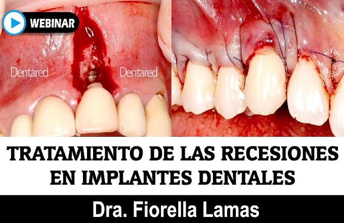 RECESIONES GINGIVALES: Tratamiento de las recesiones en Implantes Dentales ¿Verdad o Mito? - Dra. Fiorella Lamas