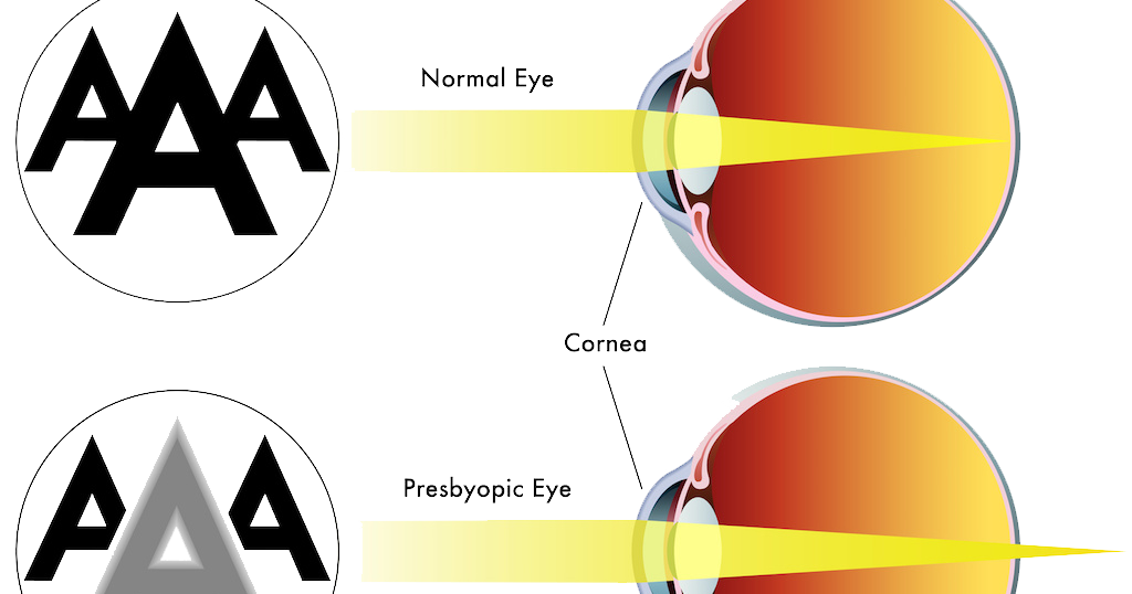 смешанный астигматизм мкб