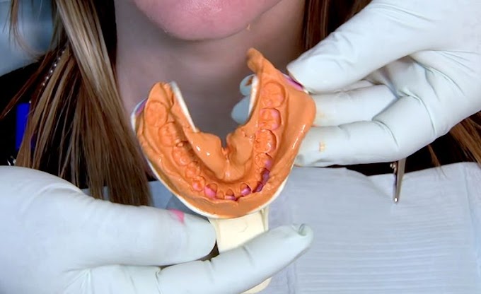 DENTAL IMPRESSION: How to take one-step impressions