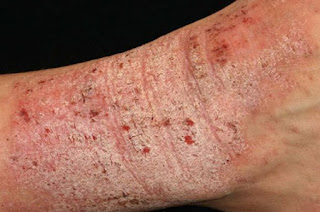 Tips Menyembuhkan Eksim di Kaki yang Menahun Tips Menyembuhkan Eksim di Kaki yang Menahun