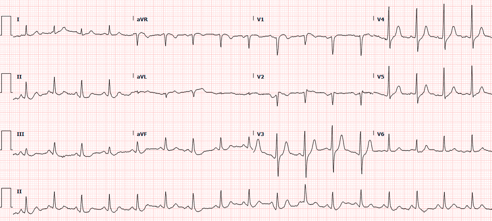 элевация сегмента st на экг v2 v3. элевация st на экг v5 v6. ишемическая элевация сегмента st норма. подъем зубца st. подъем зубца st.