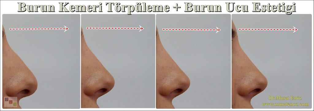 Burun Eti Büyümesi (Konka Hipertrofisi)
