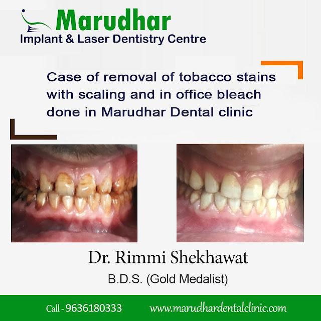 Simple Ways to Fix Tooth Decay and have a Better Teeth