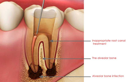 Tooth pain after filling tooth pain after filling,tooth pain,pain after filling,tooth sensitivity after filling,filling,tooth pain after deep filling,throbbing tooth pain after filling,pain after a filling,severe pain after filling,tooth pain weeks after filling,tooth pain after filling by dentist,how to relieve tooth pain after filling,is pain after tooth filling normal,what causes pain after tooth filling,tooth,nerve pain after filling,pain after cavity filling,tooth filling,teeth pain