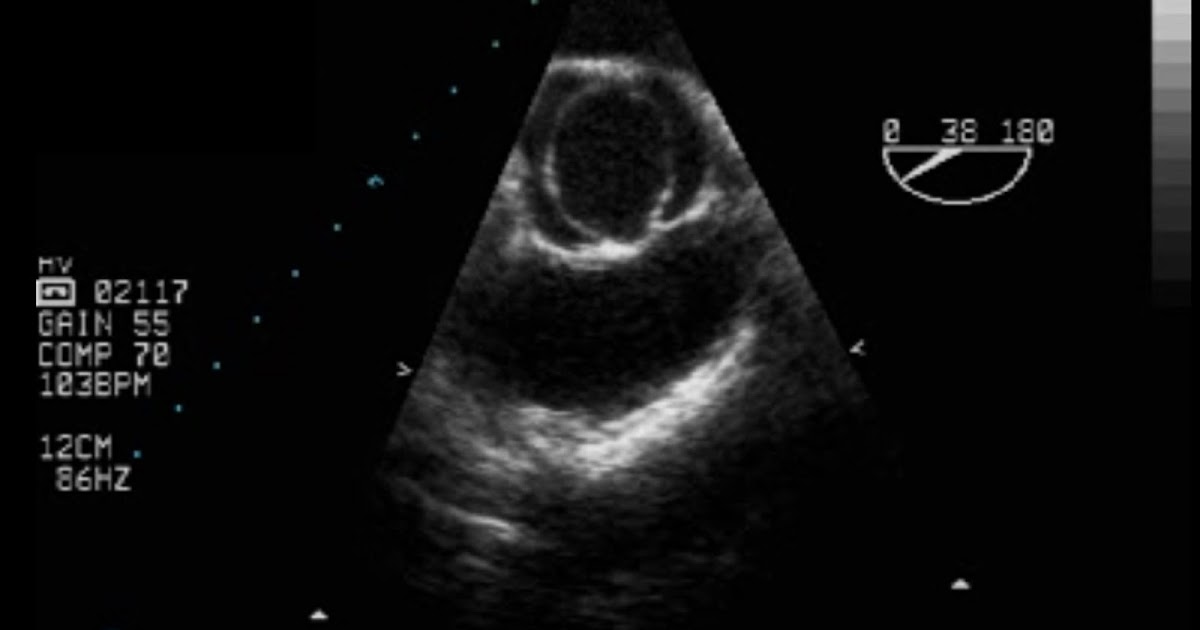 Andrew R. Houghton Ten key facts about bicuspid aortic valve disease