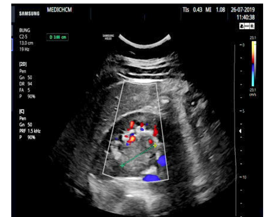 VIETNAMESE MEDIC ULTRASOUND CASE 560 TUMOR IN HORSESHOE KIDNEY, Dr