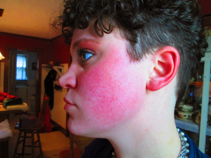 Scarlet Letters, dealing with vascular rosacea, face flushing, burning