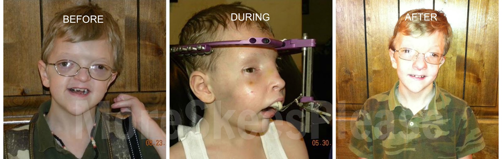 What Is the MidFace Advancement Surgery and the RED device?