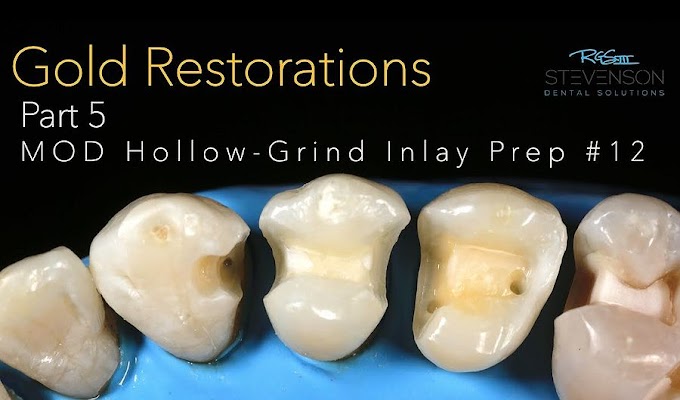 CAST GOLD Restorations - PART 5: MOD HOLLOW-GRIND INLAY #12 -  Dr. Richard Stevenson