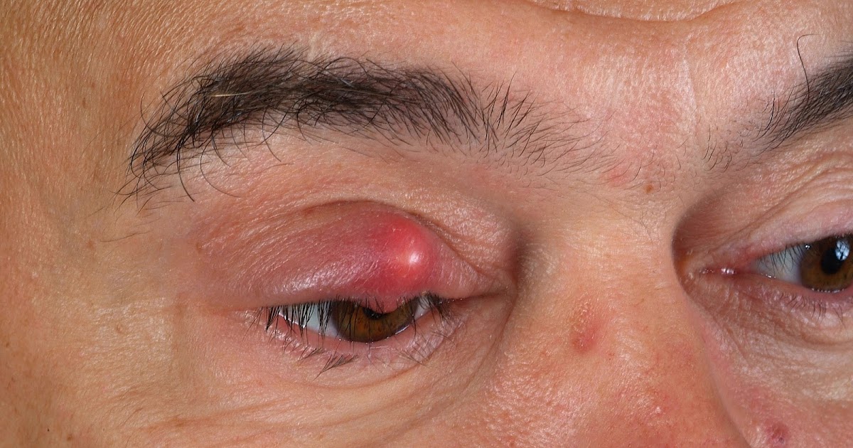 What is hordeolum(Blepharitis)?