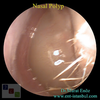 Nasal Polyp - Definition, Symptoms, Diagnosis and Treatment