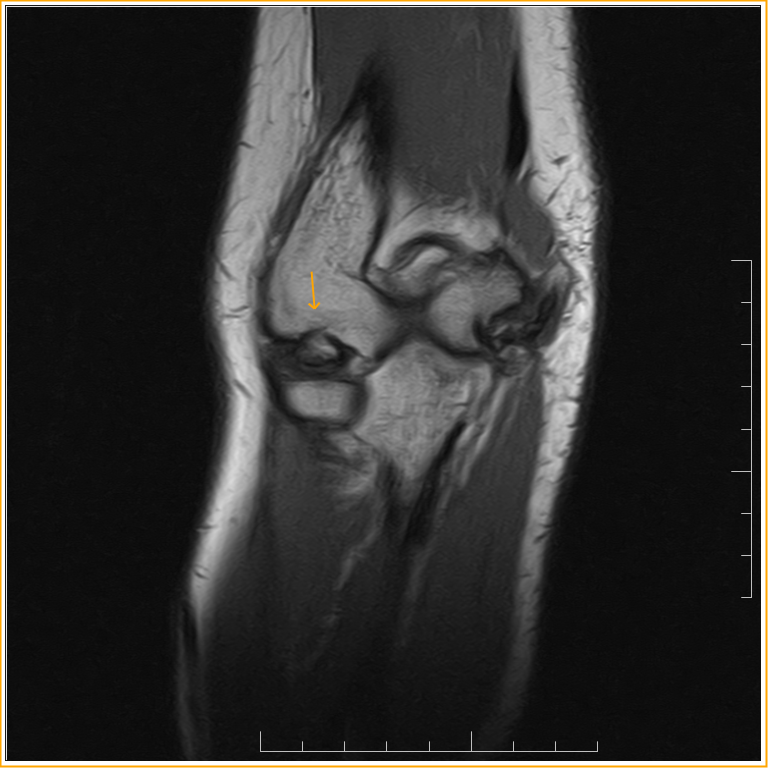 Osteochondritis of the ElbowMRI Sumer's Radiology Blog